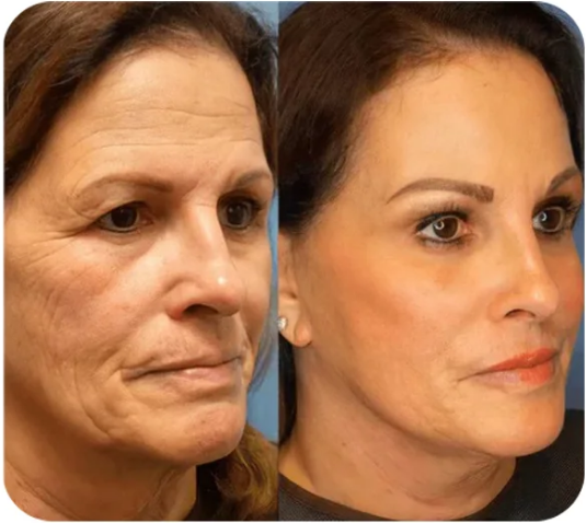 Primer lifting facial instantáneo
